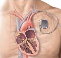 Medical Issues to Consider When Deciding Upon an Air Vest